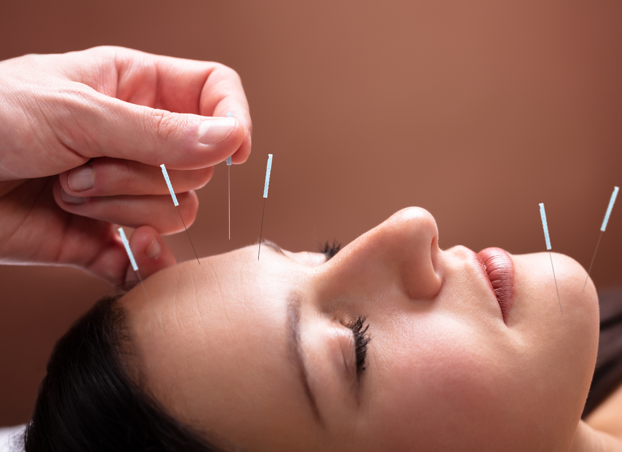 beauty treatment of a woman with acupuncture facial